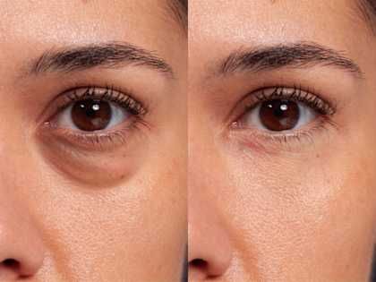 Benefits of K- ALTHERA Eye Revive and Lift Treatment